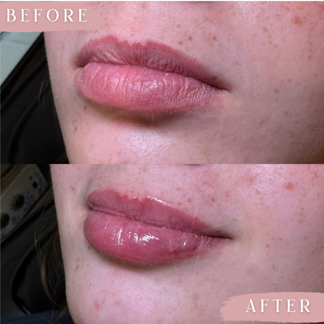 _Caroline! Half syringe Revanesse Lips + to balance and hydrate
