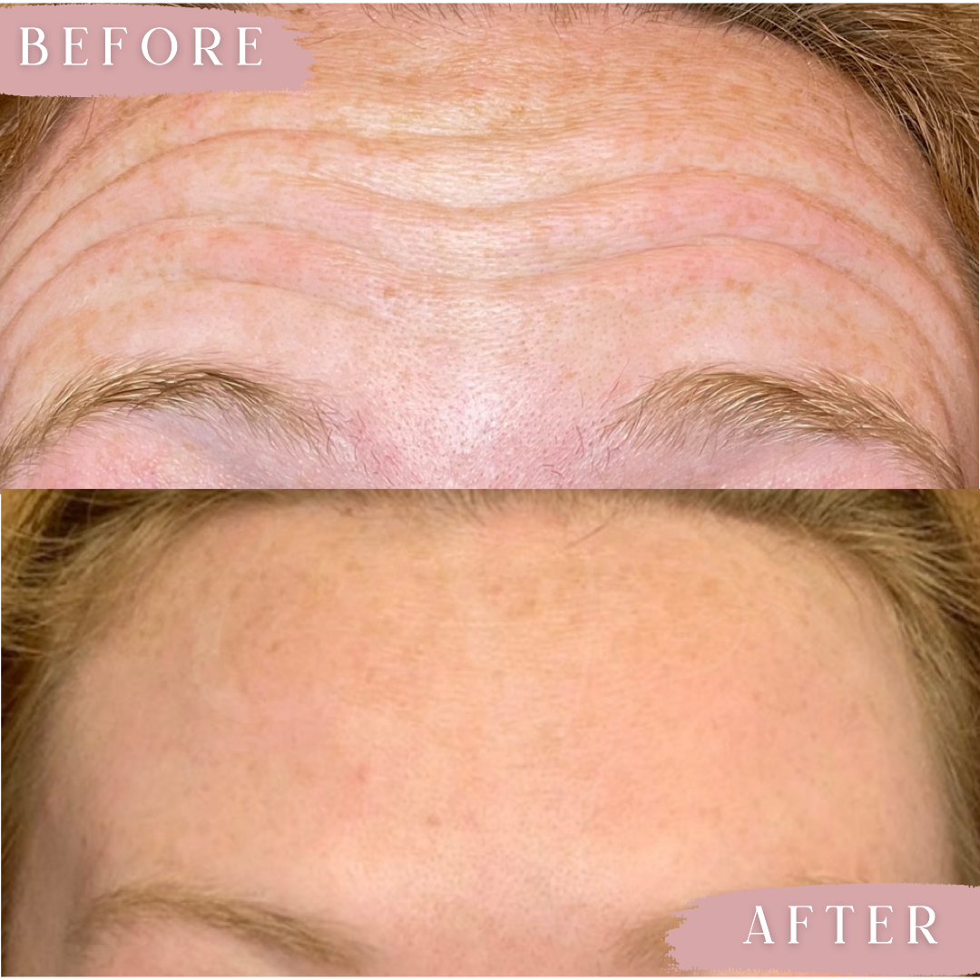 forehead tox