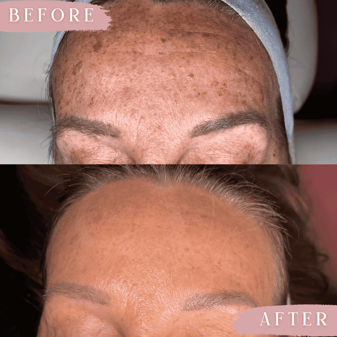 Before and Afterimage of forehead blemish reduction
